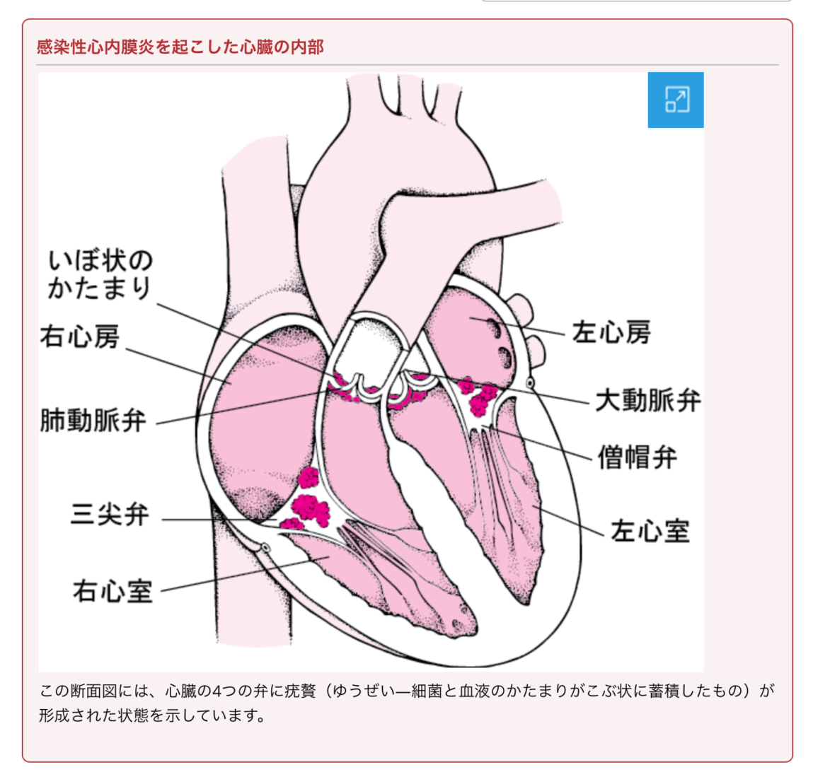 感染 性 心 内 膜 炎